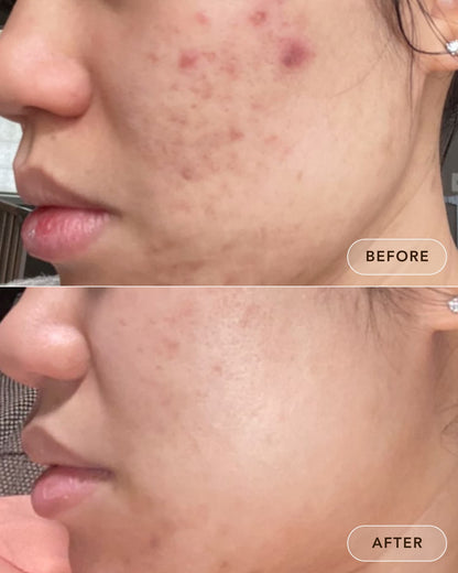 Before and after results using Dezi Skin Claro Que C Vitamin C Glow Serum showing reduced dark spots and clearer skin