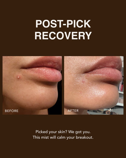 Before and after using Dezi Skin Pore Choices Repair Mist for post-pick breakout recovery
