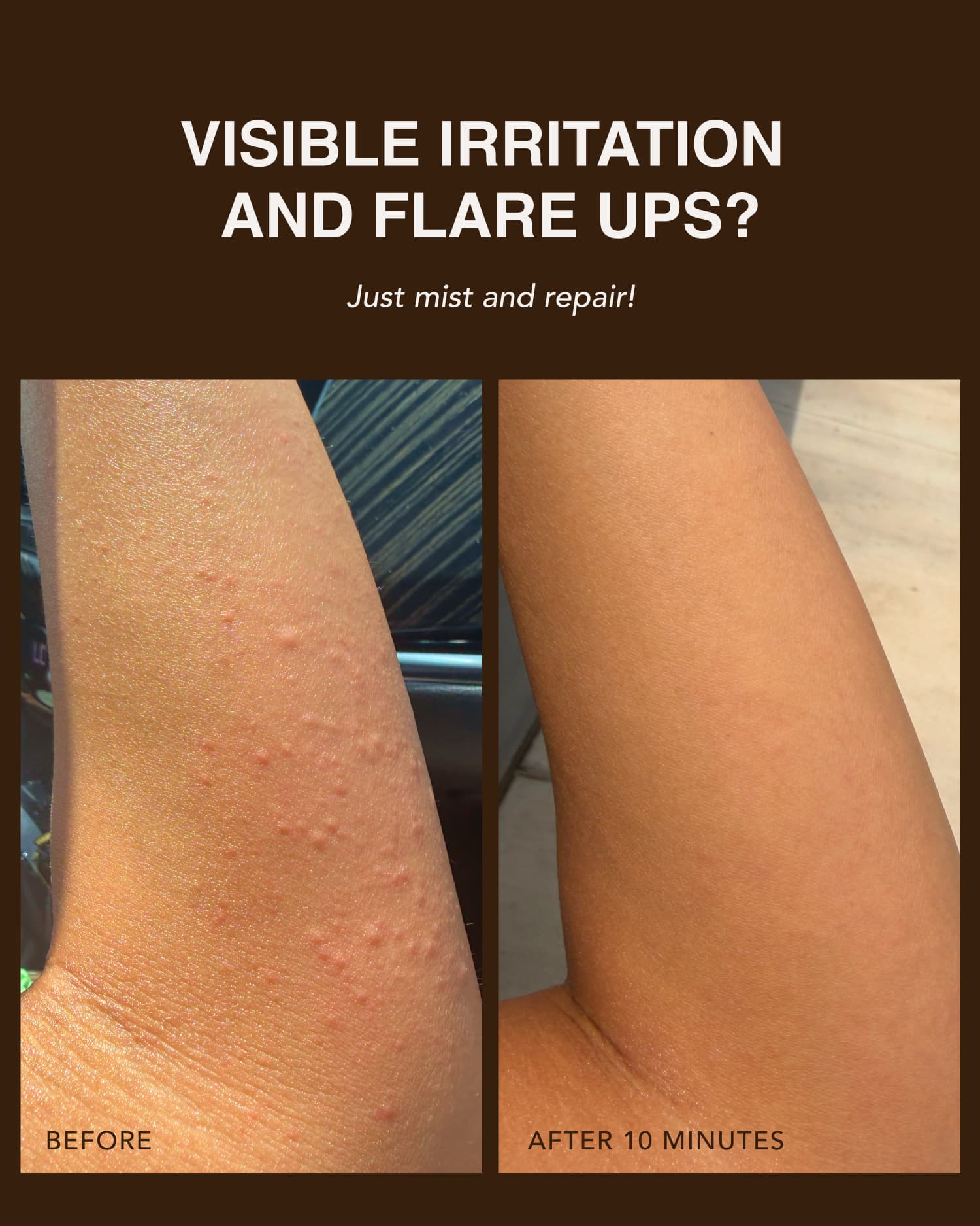 Before and after using Dezi Skin Pore Choices Repair Mist showing reduced skin irritation and flare ups in 10 minutes