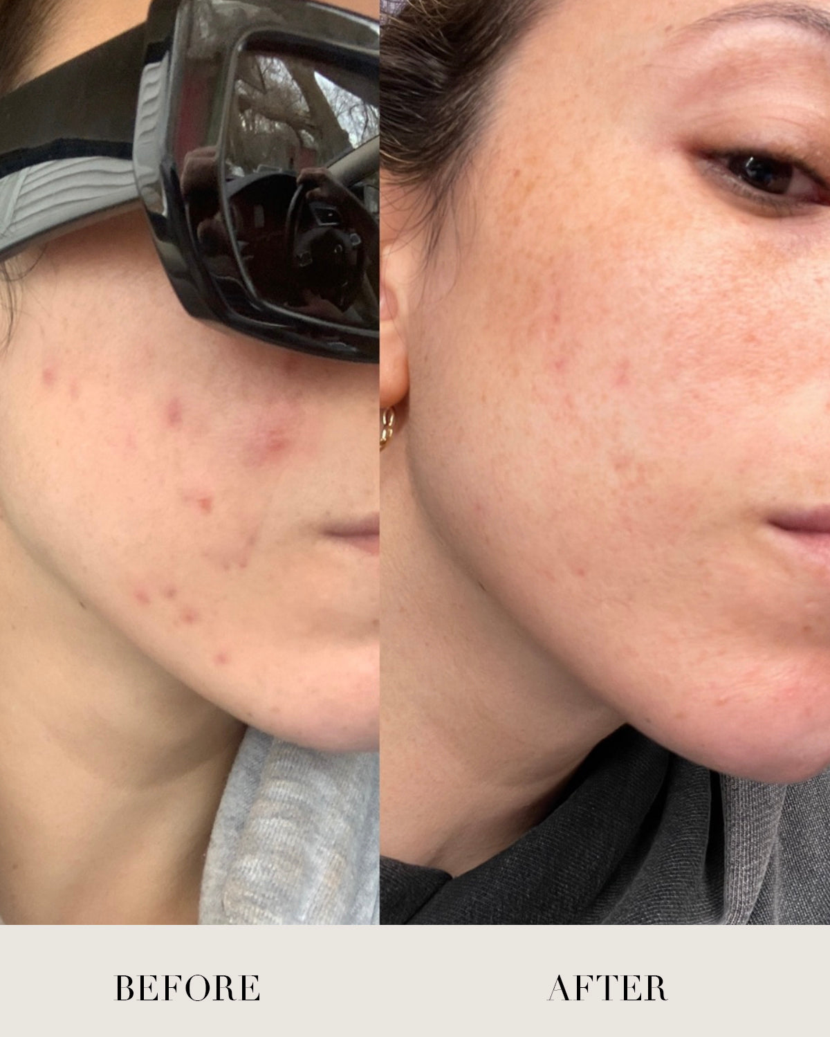 This is a before and after image of a real customer. In the before you can see hyperpigmentation and acne. In the after, her skin tone is even and acne free